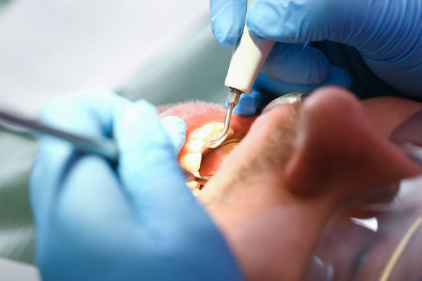 Best Emergency Wisdom Teeth Removal in Dayton, TX